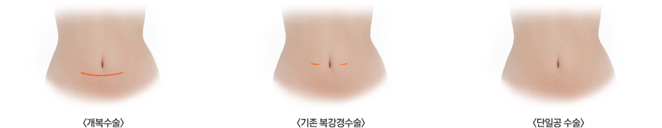 개복수술 이미지, 기존 복강경수술 이미지, 단일공 수술 이미지